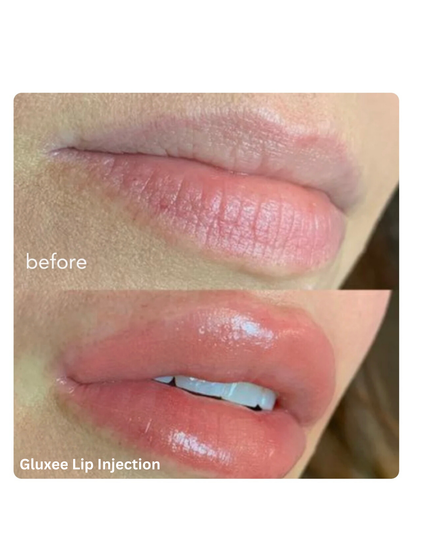 LIP INJECTION