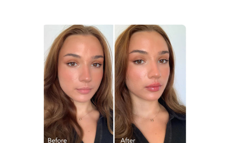 LIP INJECTION